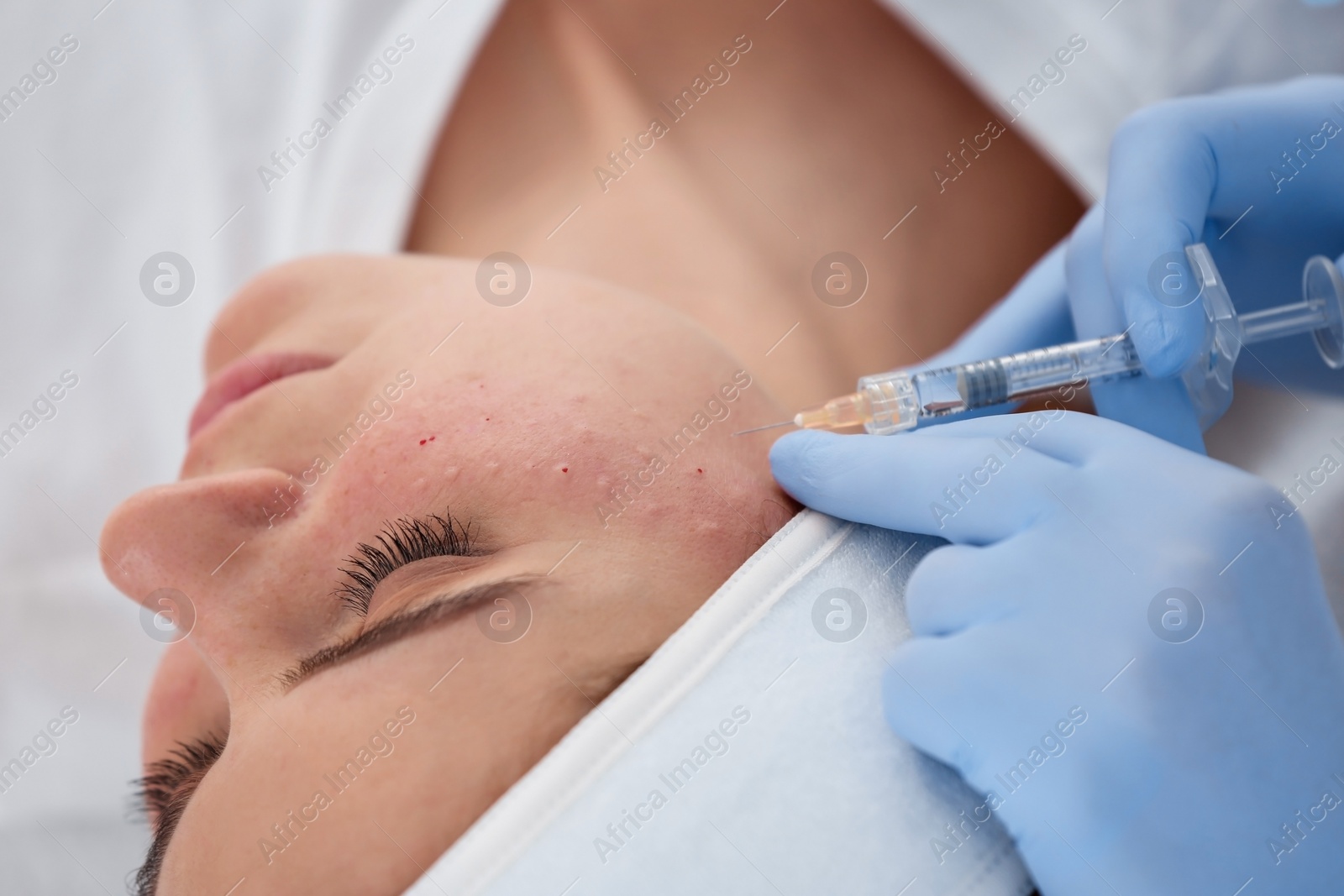 Photo of Woman undergoing face biorevitalization procedure in salon, closeup. Cosmetic treatment