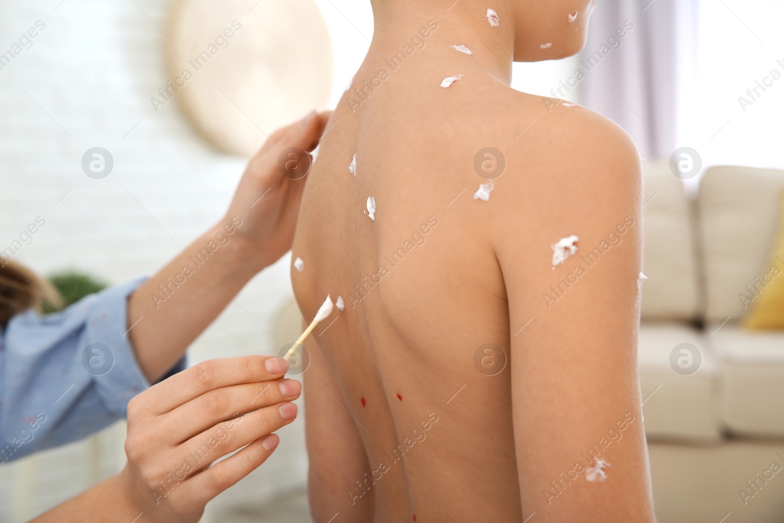 Photo of Woman applying cream onto skin of little boy with chickenpox at home, closeup