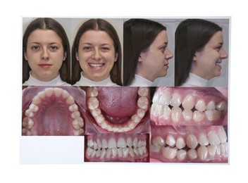 Photos of woman and her teeth from different sides isolated on white
