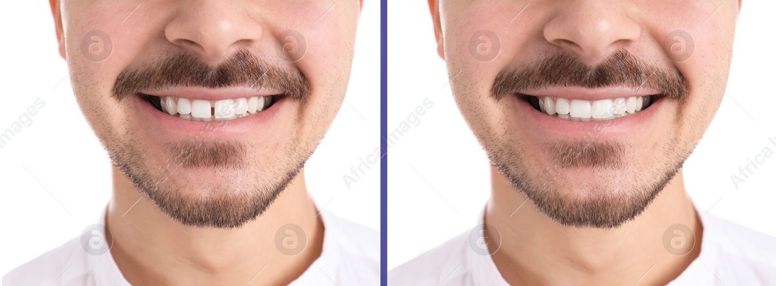 Image of Collage with photos of man with diastema between upper front teeth before and after treatment on white background, closeup. Banner design