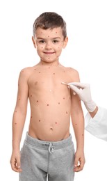 Photo of Doctor applying cream onto skin of little boy with chickenpox on white background. Varicella zoster virus