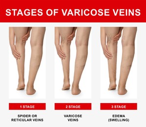 Image of Stages of varicose veins. Collage with photos of woman showing changes during different phases, closeup of legs
