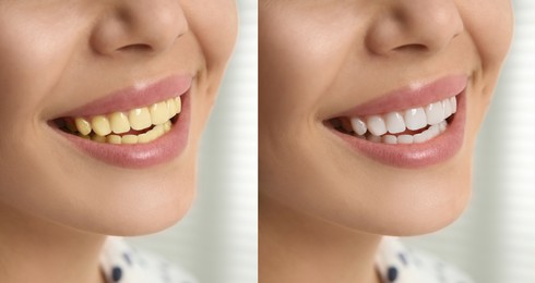Image of Collage with photos of woman before and after tooth whitening, closeup