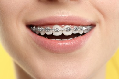 Smiling woman with dental braces on yellow background, closeup