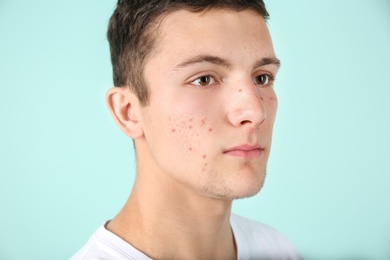 Photo of Young man with acne problem on color background