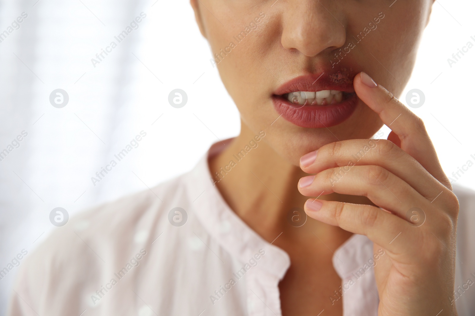 Photo of Woman with herpes touching lips against light background, closeup