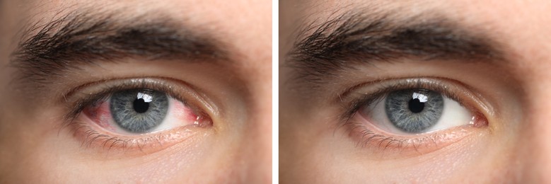 Image of Collage with photos of man with inflamed and healthy eyes before and after treatment, closeup. Banner design