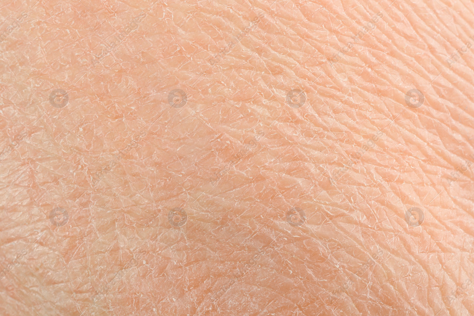 Photo of Texture of dry skin as background, macro view