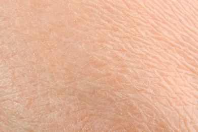 Photo of Texture of dry skin as background, macro view