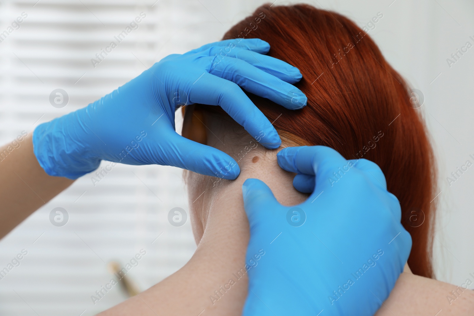 Photo of Dermatologist examining patient's birthmark in clinic, closeup view