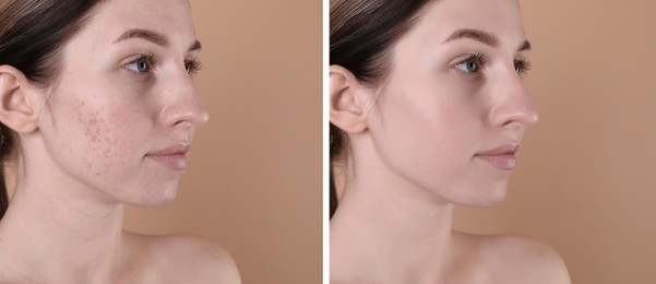 Image of Acne problem. Young woman before and after treatment on beige background, collage of photos