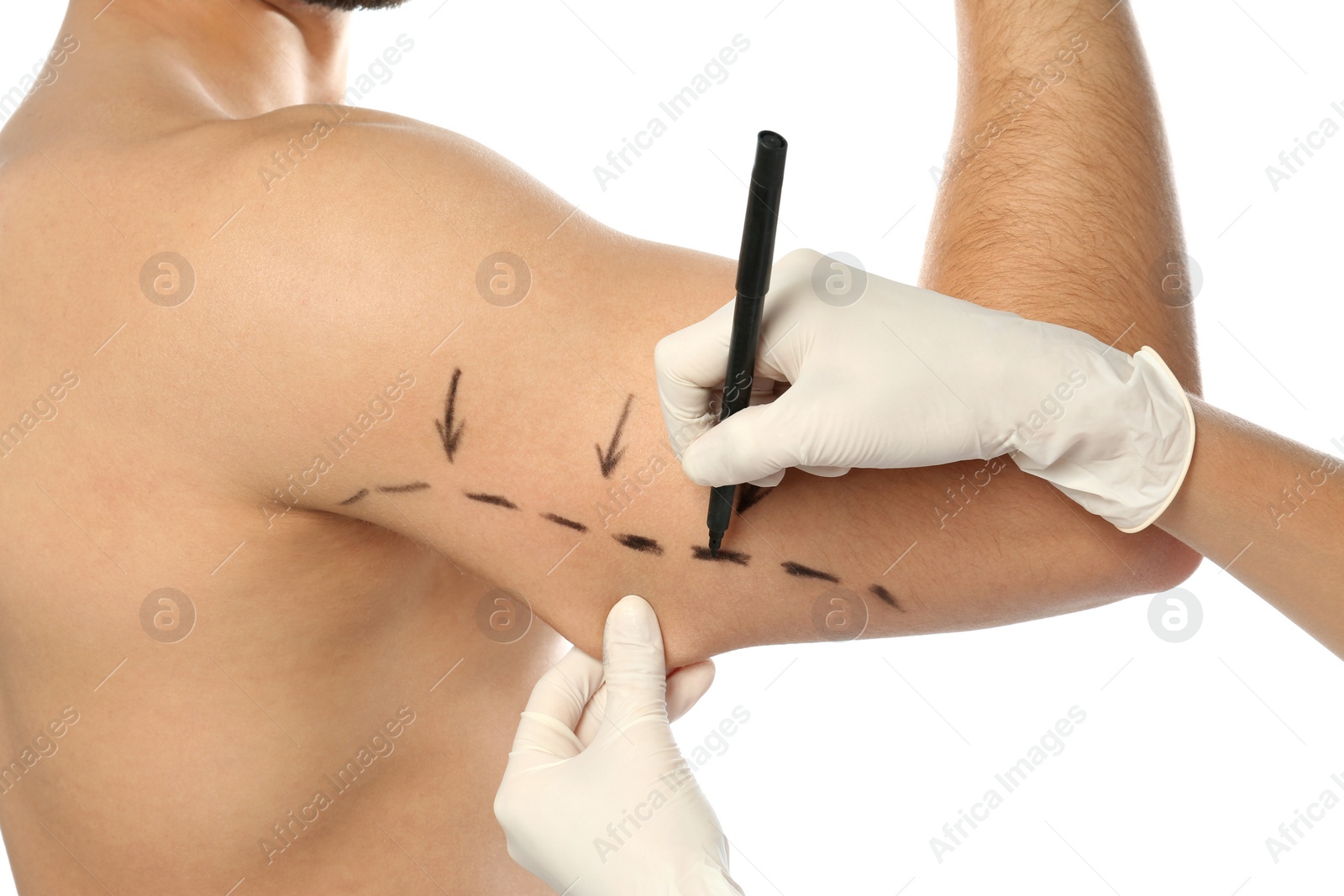 Photo of Doctor drawing marks on man's arm for cosmetic surgery operation against white background, closeup
