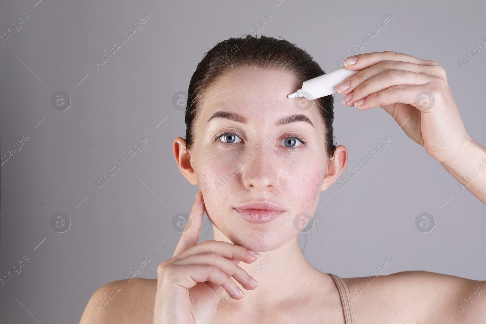 Photo of Young woman with acne problem applying cosmetic product onto her skin on light grey background