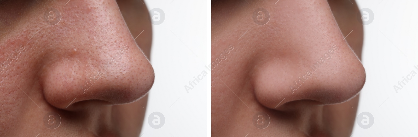 Image of Before and after acne treatment. Photos of woman on white background, closeup. Collage showing affected and healthy skin