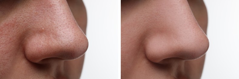 Before and after acne treatment. Photos of woman on white background, closeup. Collage showing affected and healthy skin