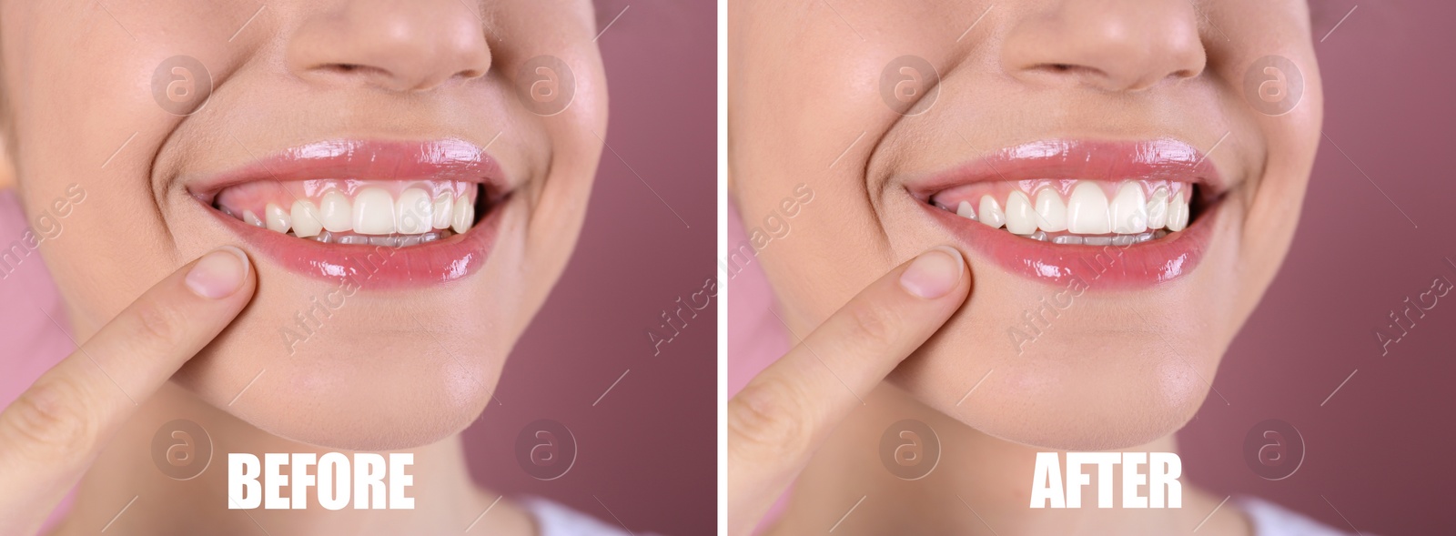 Image of Young woman before and after gingivoplasty procedure on pink background, closeup. Banner design