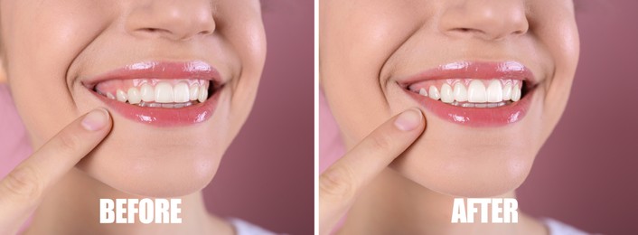 Young woman before and after gingivoplasty procedure on pink background, closeup. Banner design