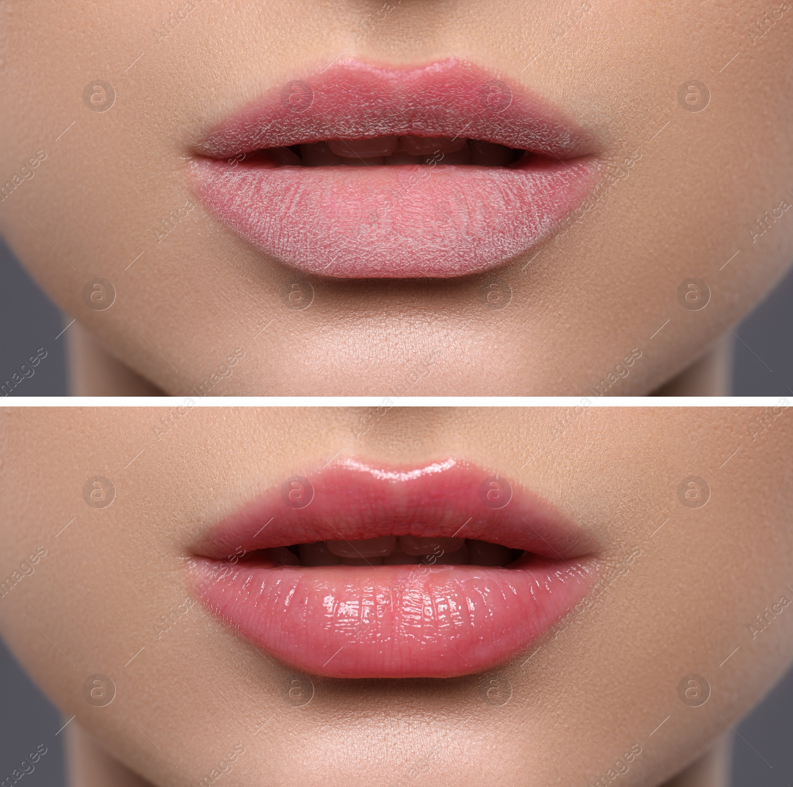 Image of Collage with photos of woman with dry and moisturized lips, closeup