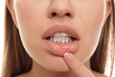 Image of Young woman with cold sore touching lip, closeup