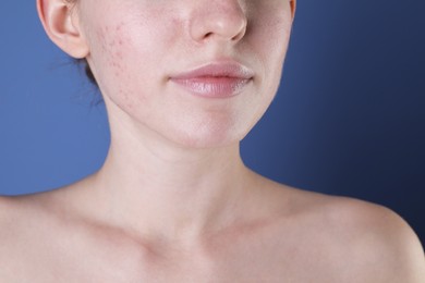 Photo of Young woman with acne problem on blue background, closeup