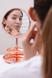 Woman with acne problem looking at mirror indoors