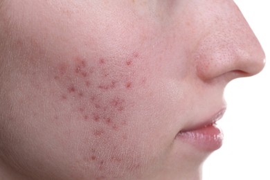 Young woman with acne problem on white background, closeup