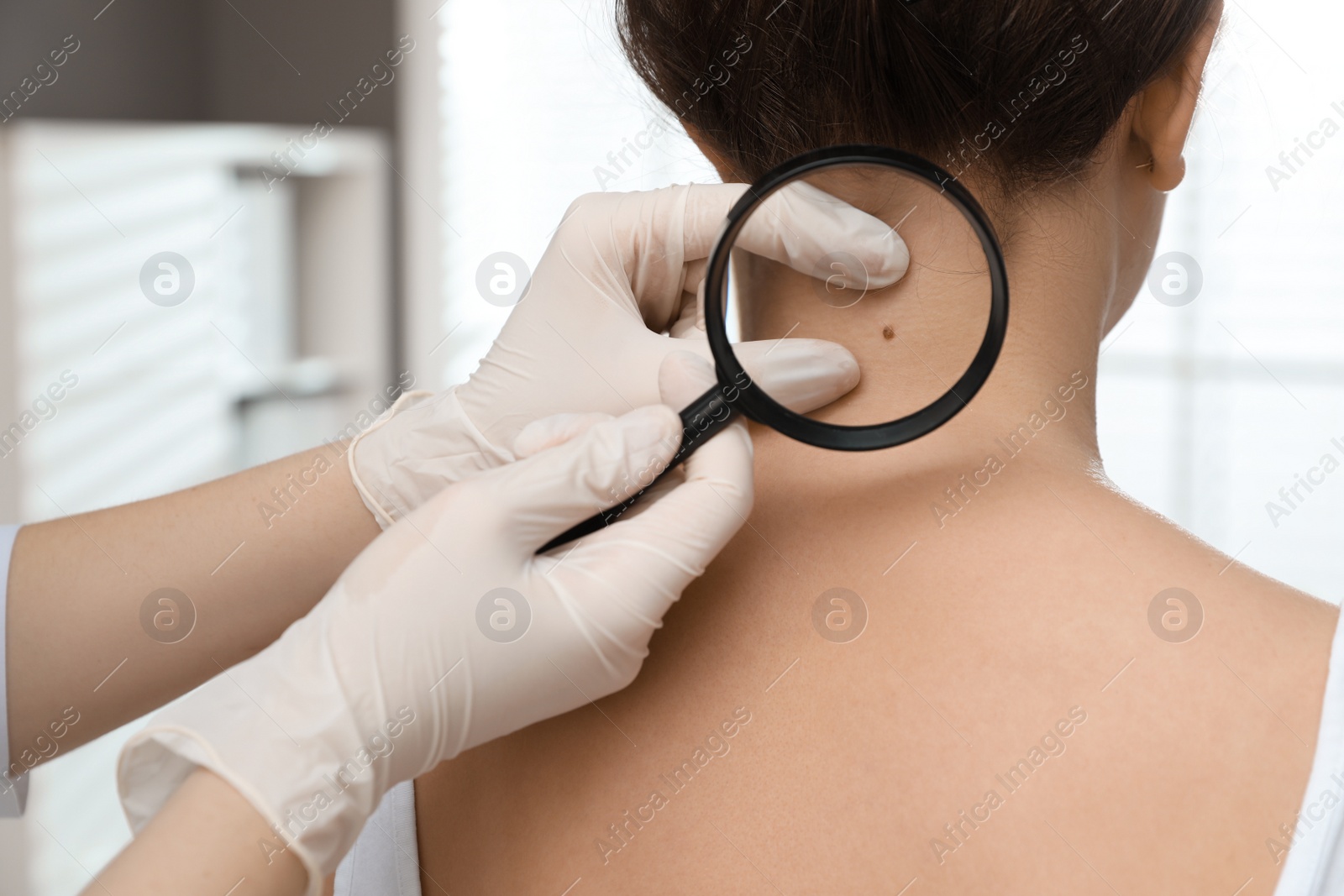 Photo of Dermatologist examining patient's birthmark with magnifying glass in clinic, closeup view