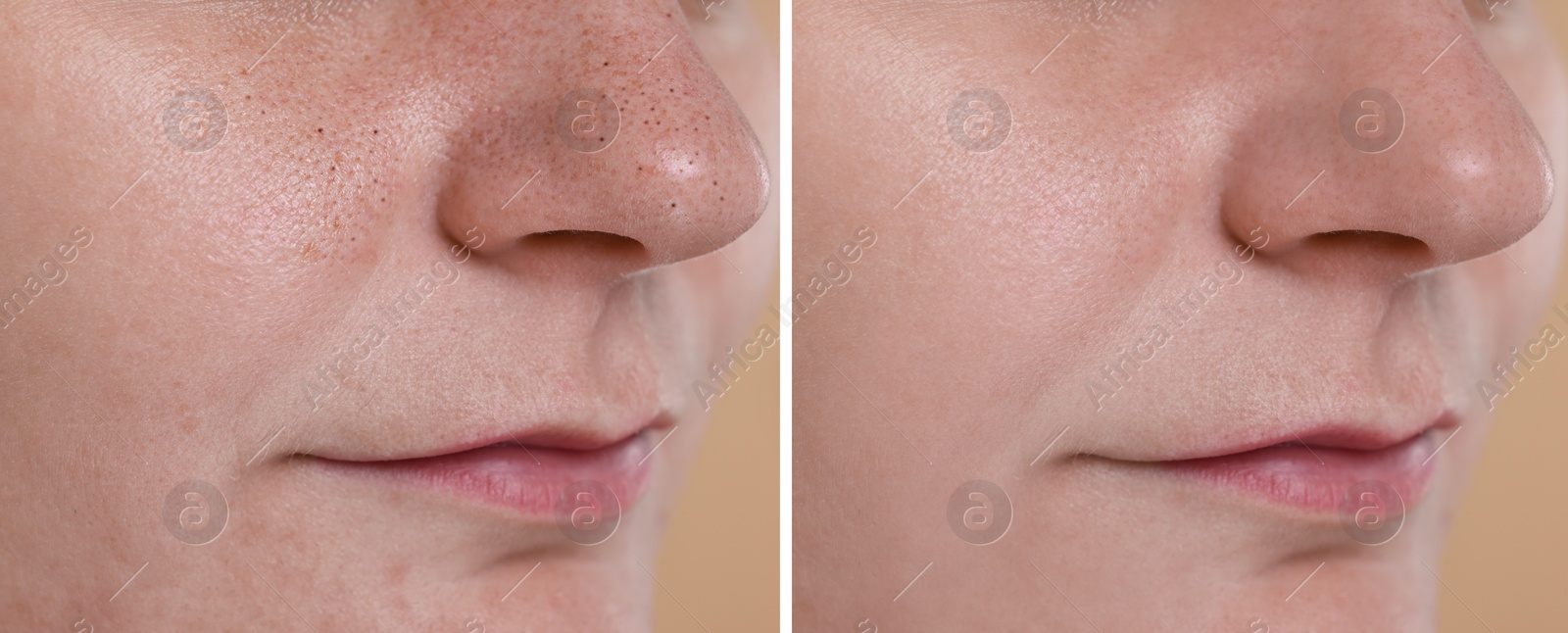 Image of Blackhead treatment, before and after. Collage with photos of woman, closeup view