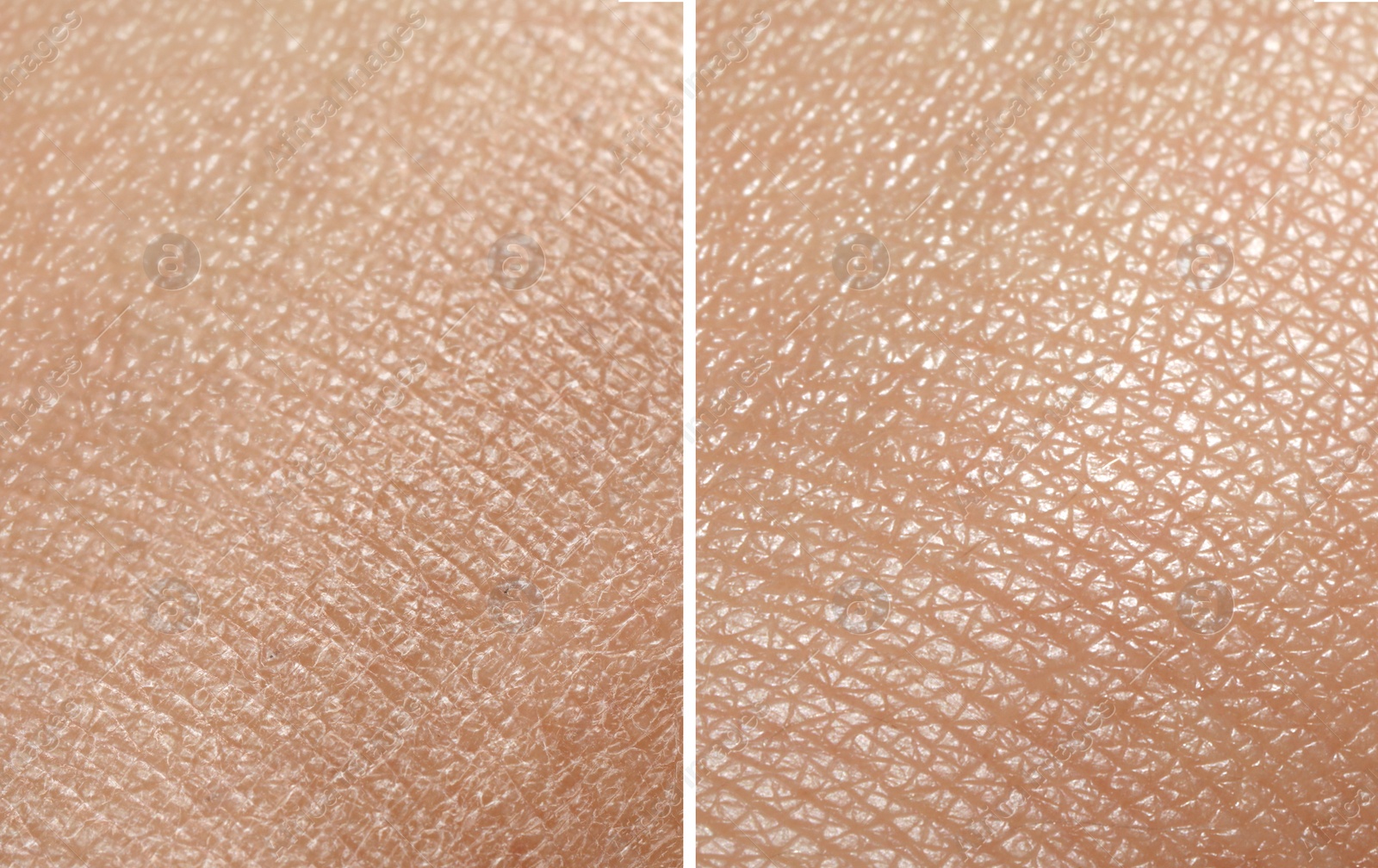 Image of Collage demonstrating comparison of dry and moisturized human skin, closeup