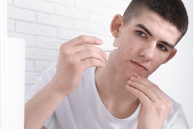 Young man with acne problem applying cosmetic product onto his skin indoors