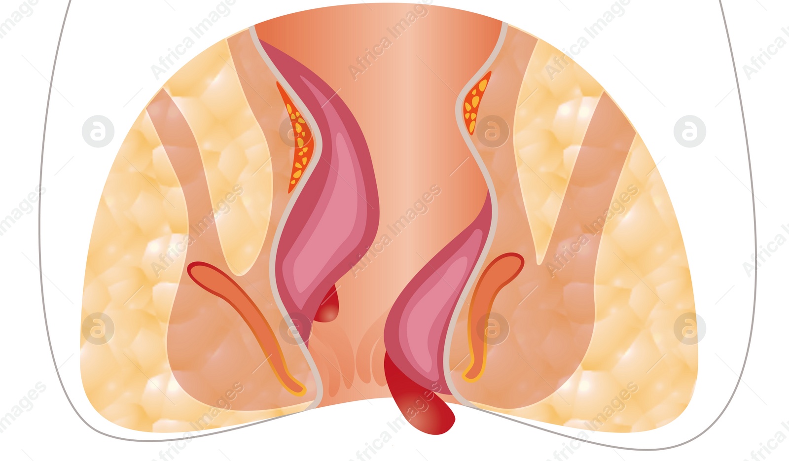 Image of Hemorrhoid. Unhealthy lower rectum with inflamed vascular structures, illustration