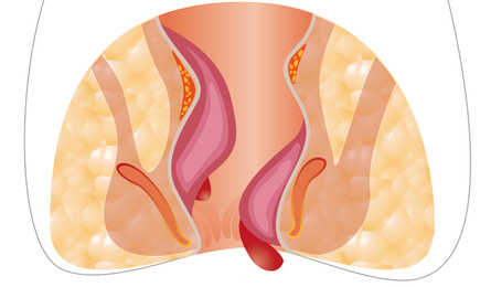 Image of Hemorrhoid. Unhealthy lower rectum with inflamed vascular structures, illustration
