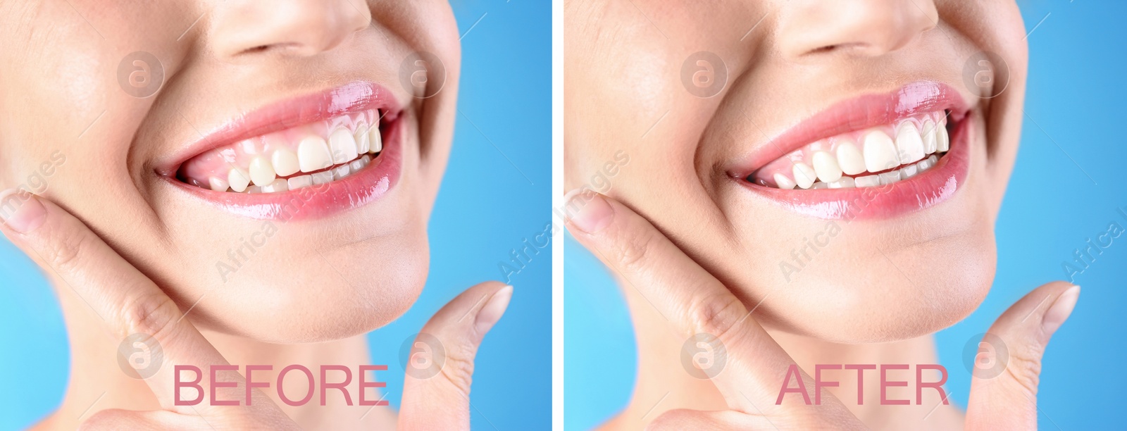 Image of Young woman before and after gingivoplasty procedure on light blue background, closeup. Banner design
