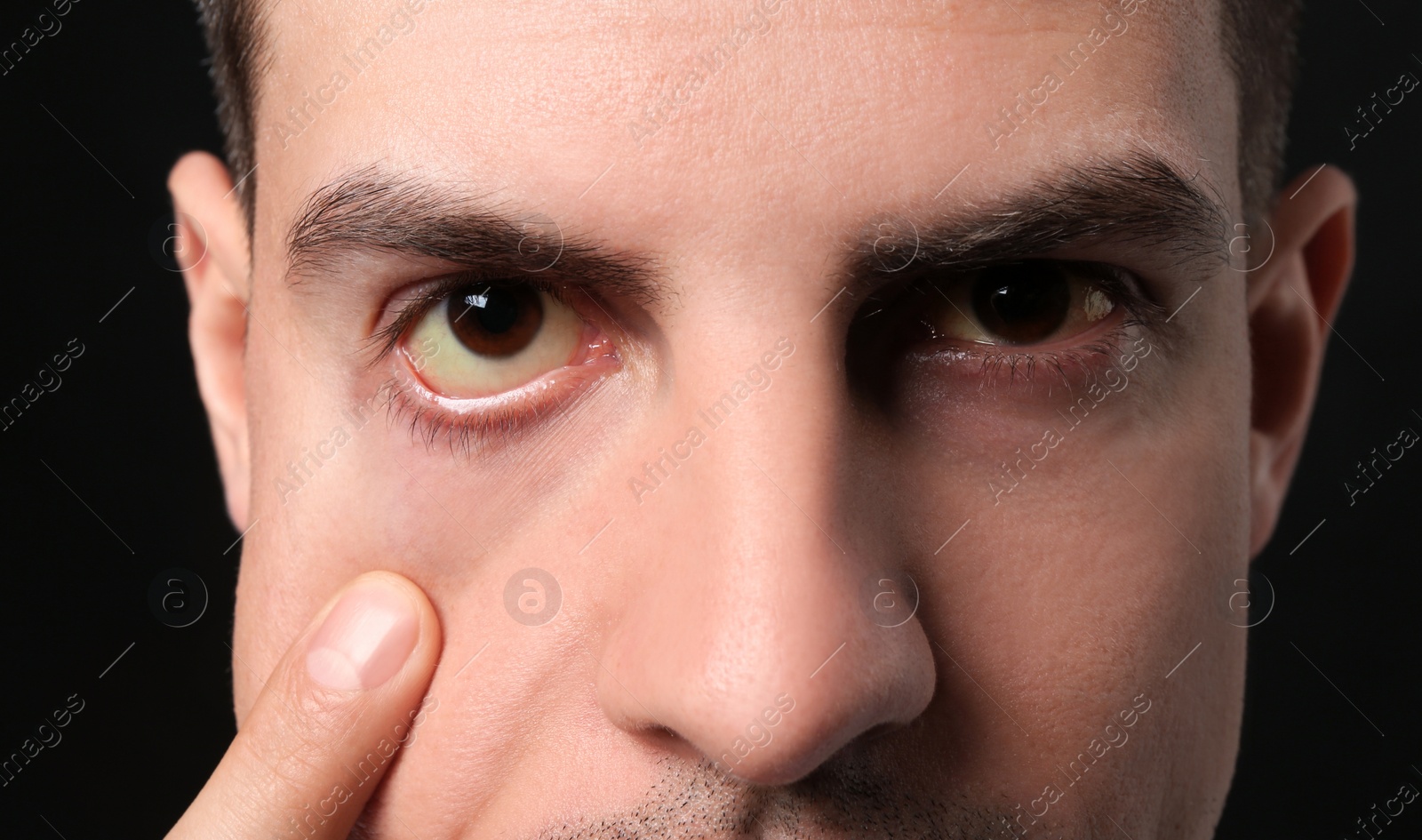 Photo of Man checking his health condition on black background, closeup. Yellow eyes as symptom of problems with liver