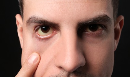 Photo of Man checking his health condition on black background, closeup. Yellow eyes as symptom of problems with liver