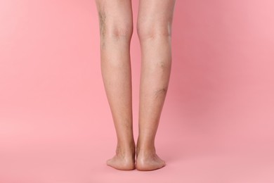 Closeup view of woman with varicose veins on pink background