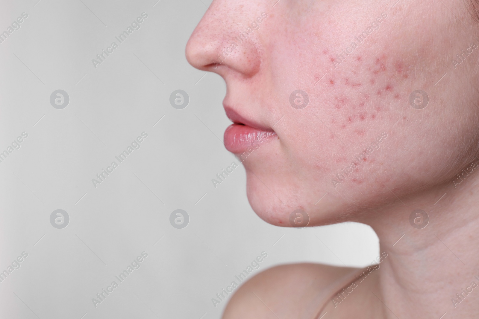 Photo of Young woman with acne problem on light grey background, closeup. Space for text