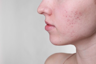 Young woman with acne problem on light grey background, closeup. Space for text