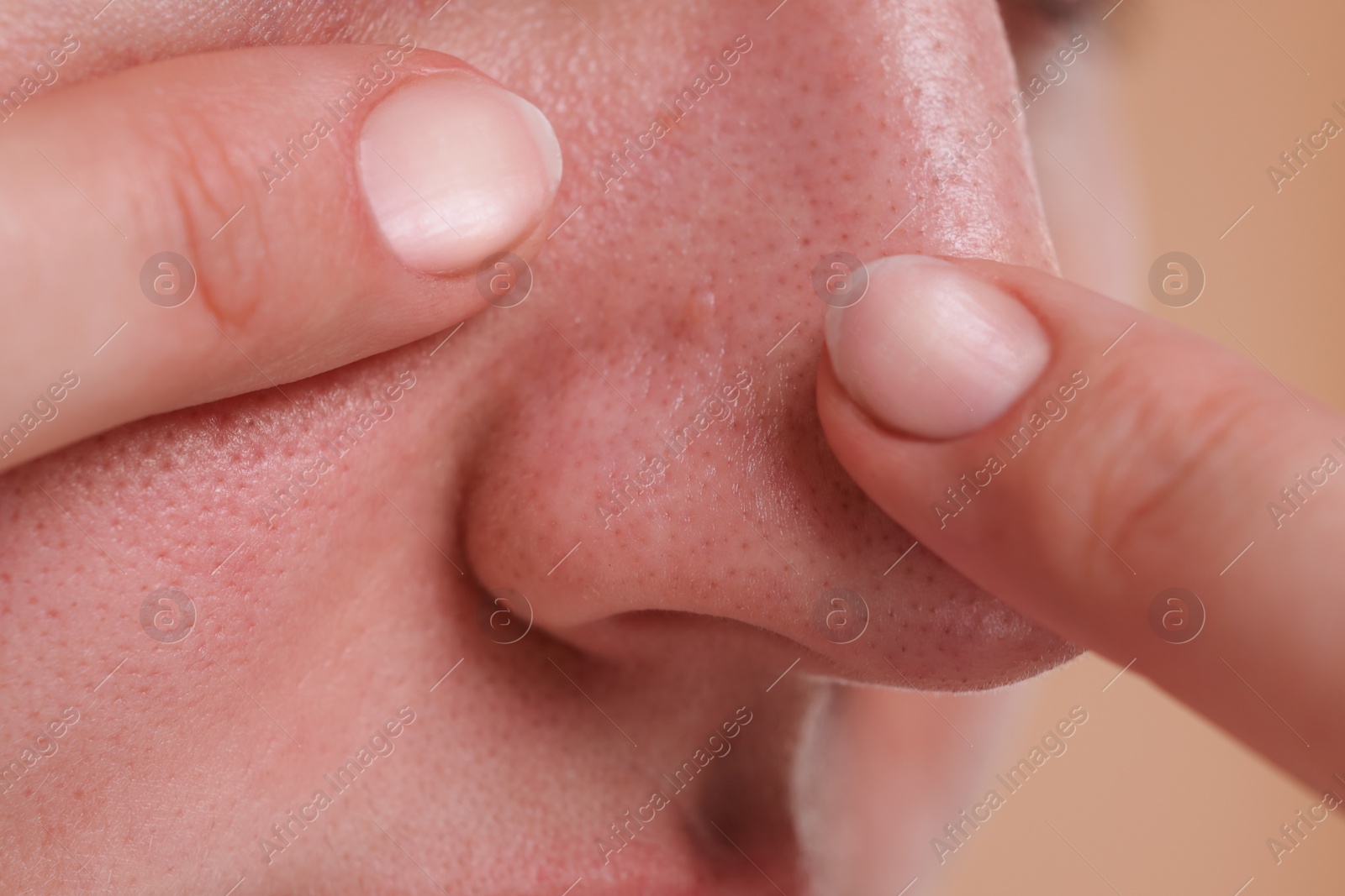 Photo of Woman popping pimple on her nose, closeup