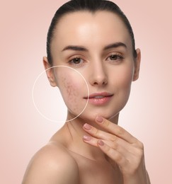 Woman with acne on her face on beige gradient background. Zoomed area showing problem skin