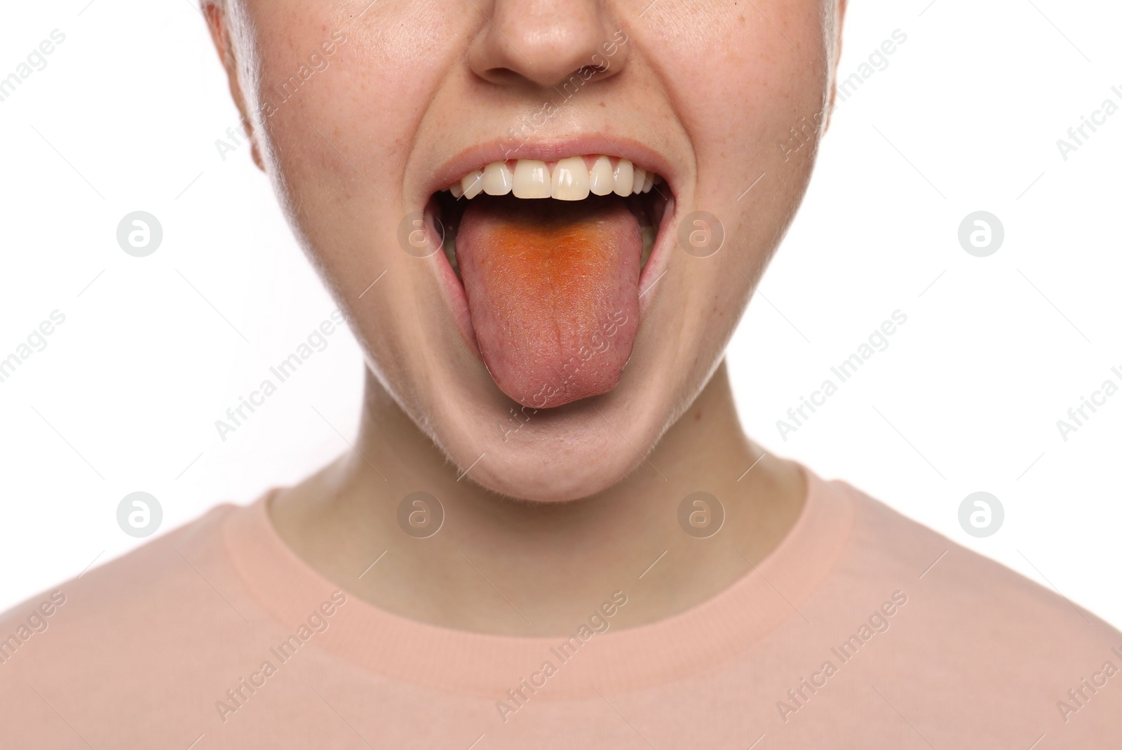 Photo of Gastrointestinal diseases. Woman showing her yellow tongue on white background, closeup