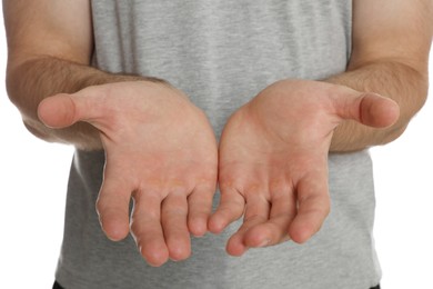 Photo of Man suffering from calluses on hands against white background, closeup