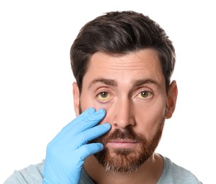 Doctor checking man with yellow eyes on white background. Symptom of hepatitis