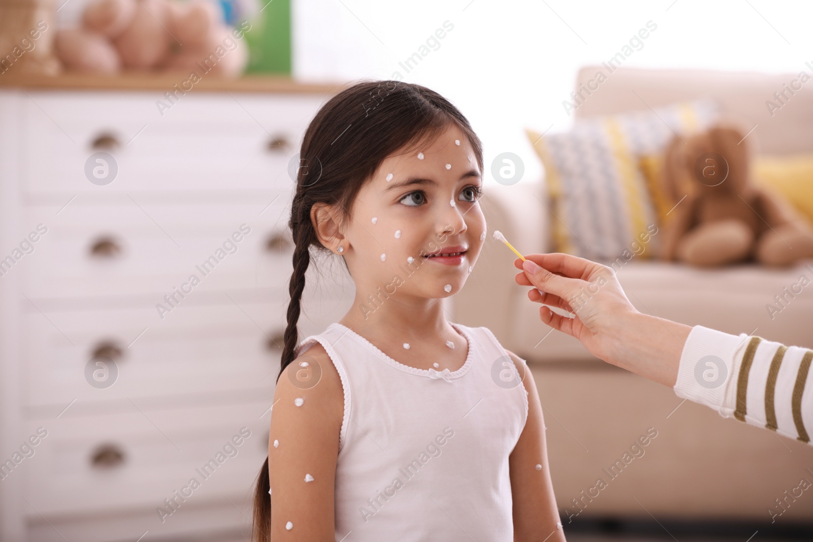 Photo of Mother applying cream onto skin of her daughter with chickenpox at home