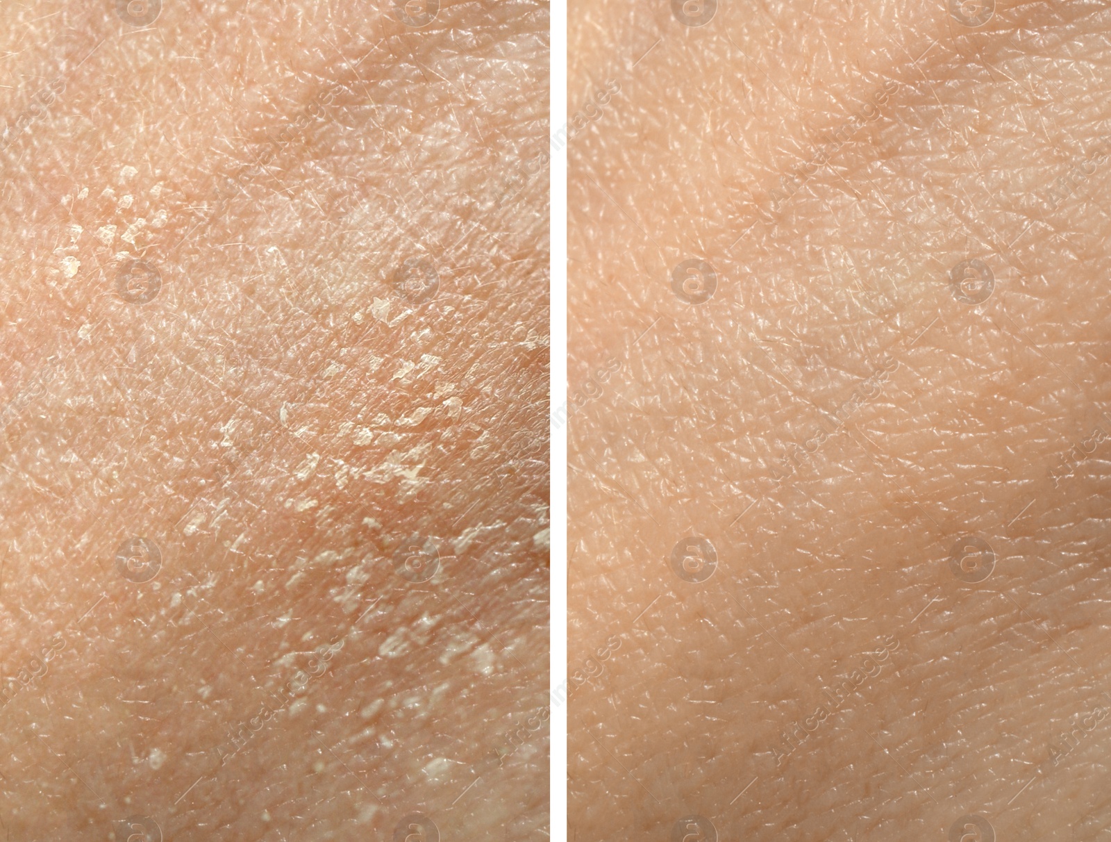 Image of Collage demonstrating comparison of dry and moisturized human skin, closeup