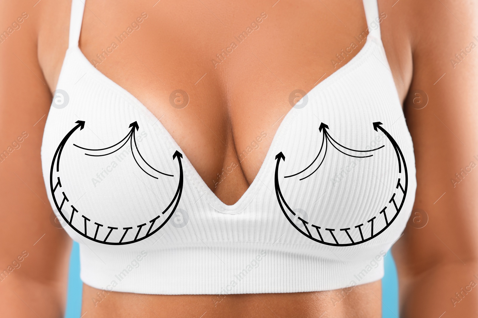 Image of Breast surgery. Woman with markings on bra, closeup