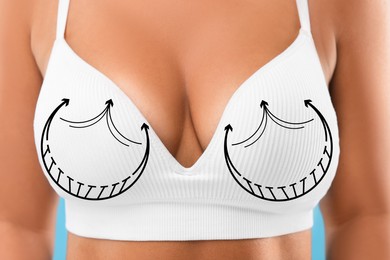 Breast surgery. Woman with markings on bra, closeup