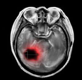 Illustration of  X-ray of patient with brain cancer. Illustration