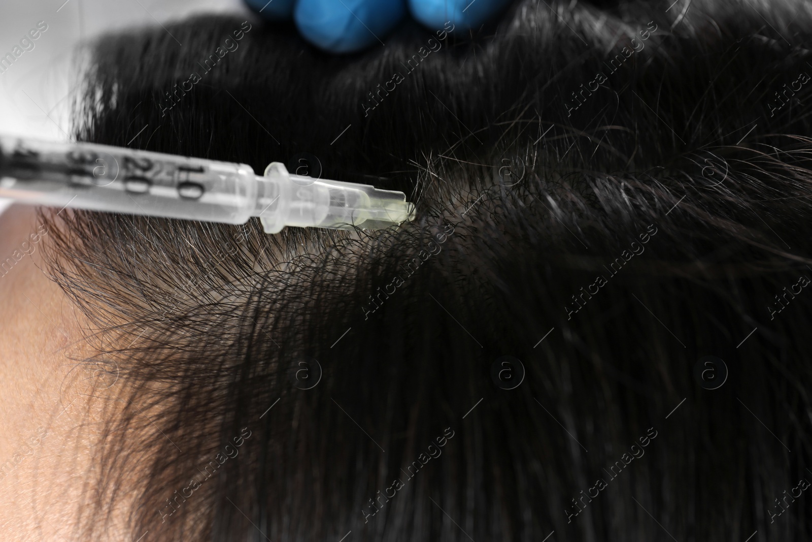 Photo of Young woman with hair loss problem receiving injection, closeup