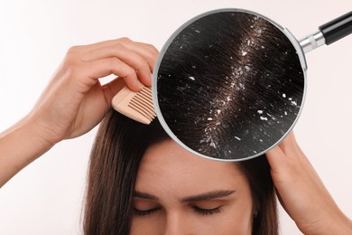 Woman suffering from dandruff on white background, closeup. View through magnifying glass on hair with flakes
